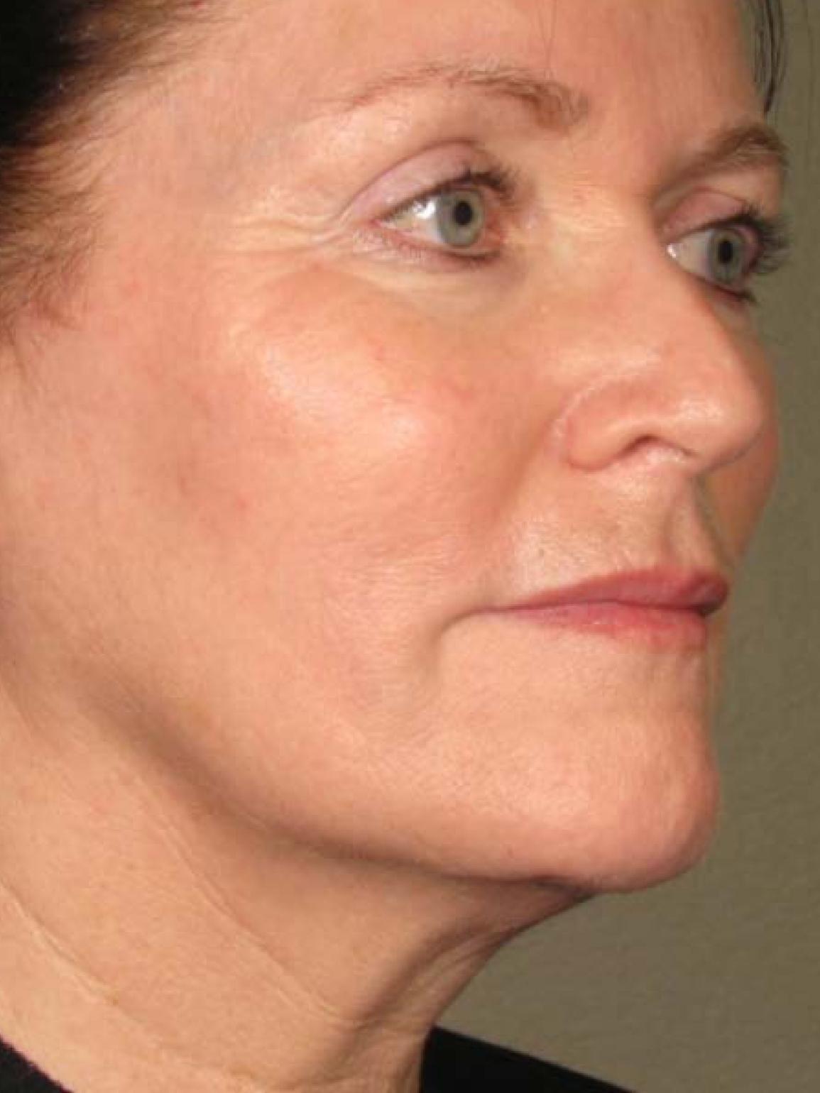 Ultherapy® - Face: Patient 22 - After 1