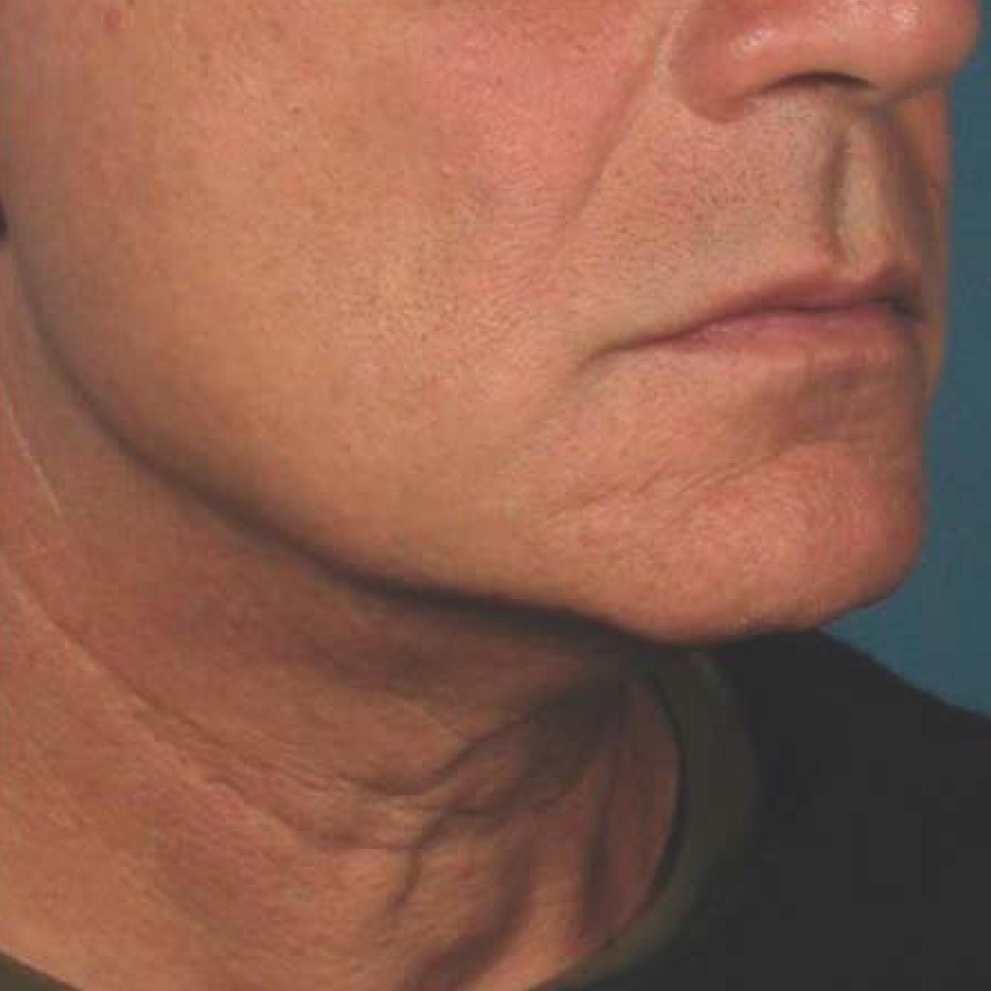 Ultherapy® - Chin: Patient 40 - After 