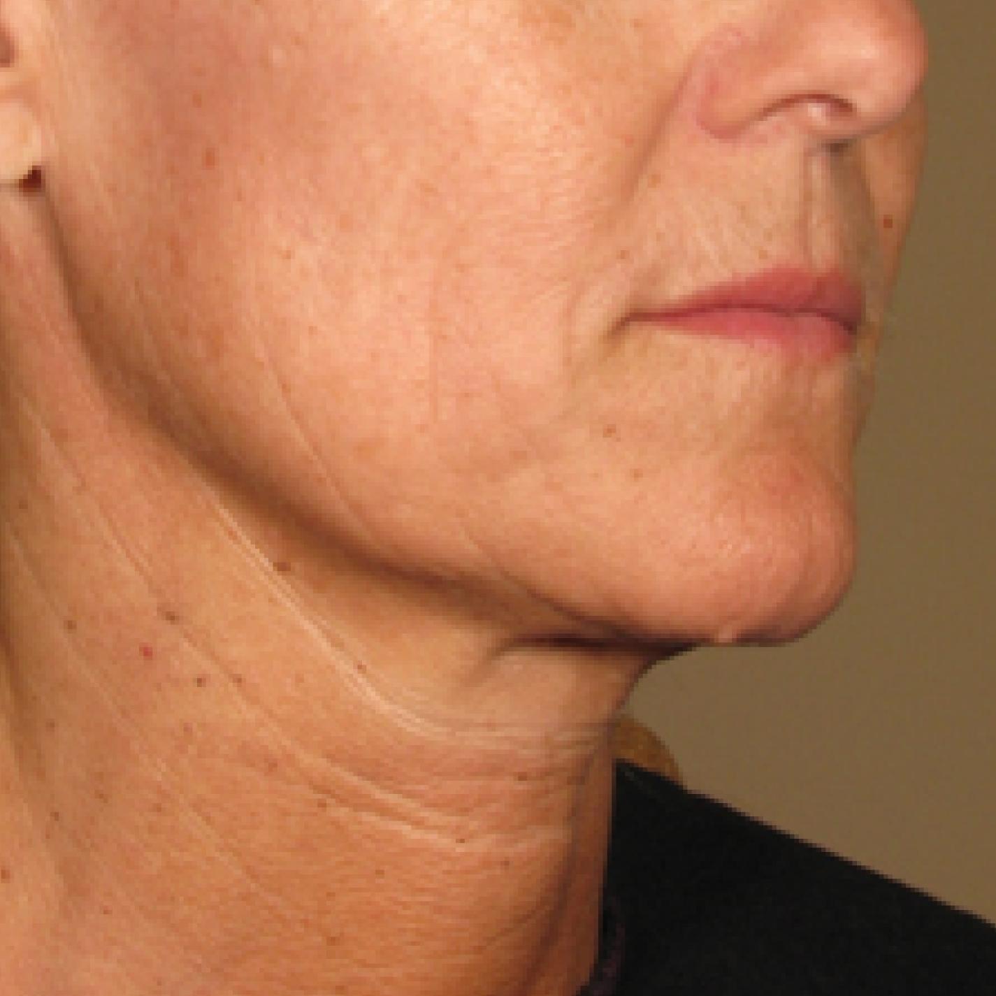 Ultherapy® - Chin: Patient 3 - After  