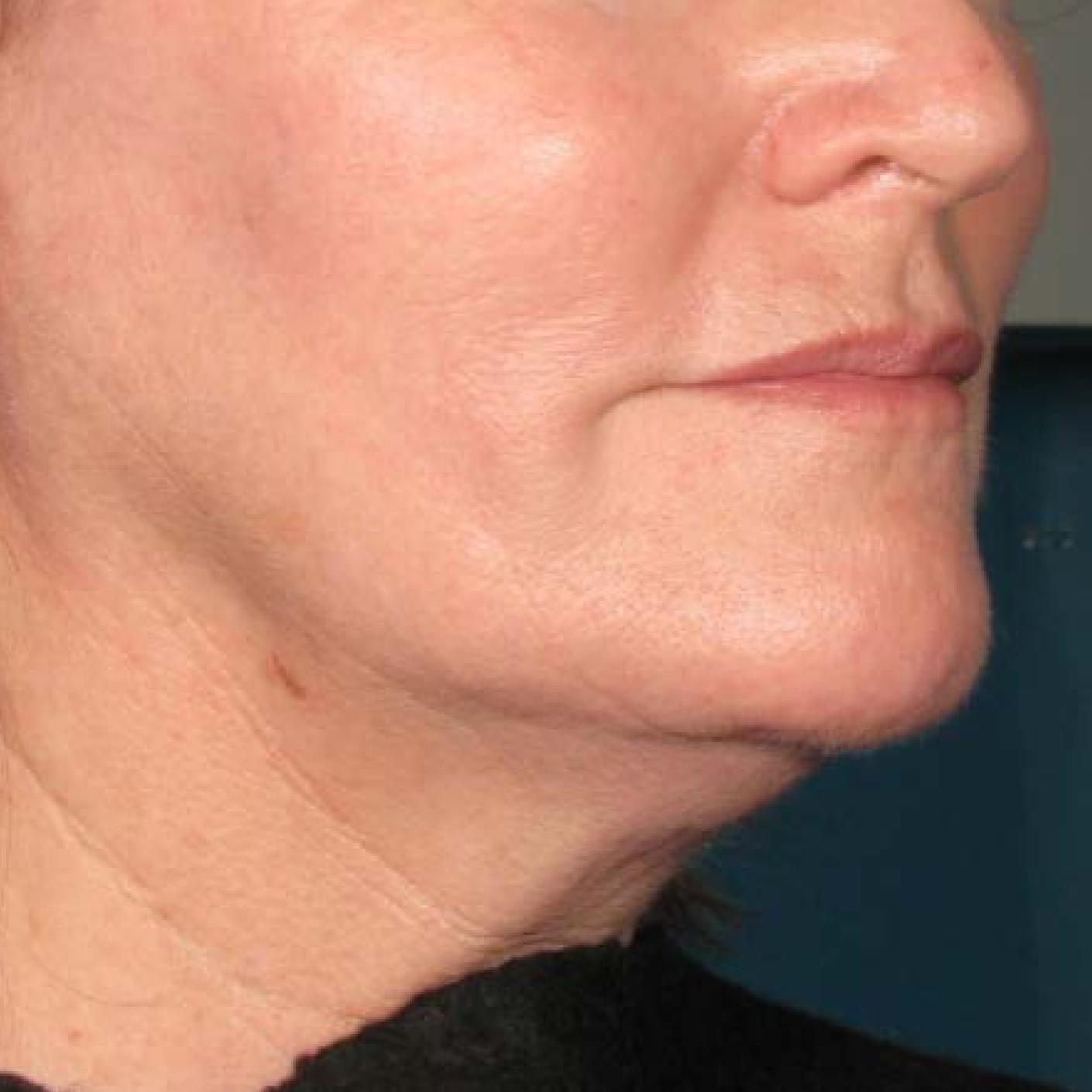 Ultherapy® - Chin: Patient 34 - Before 