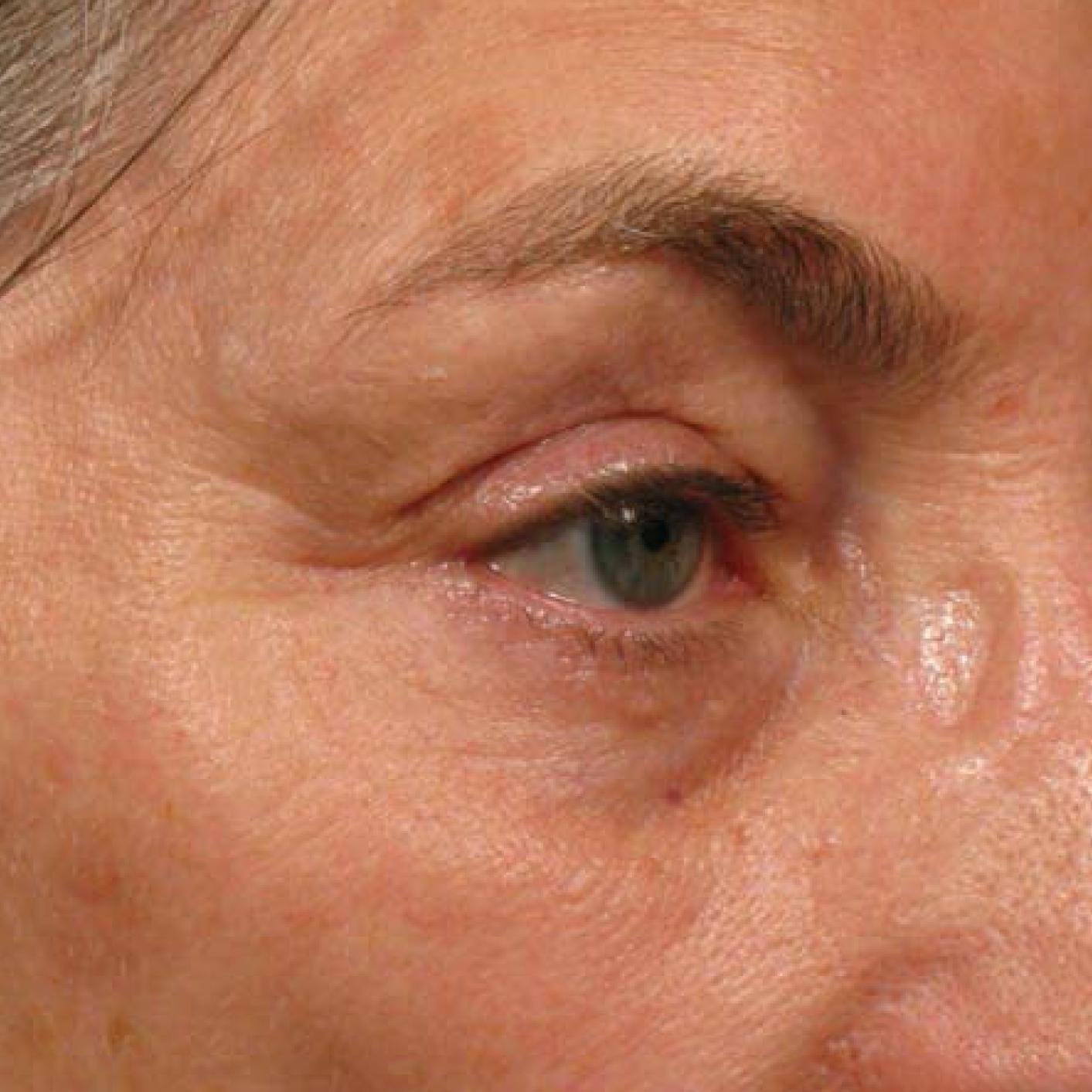 Ultherapy® - Brow: Patient 6 - After  