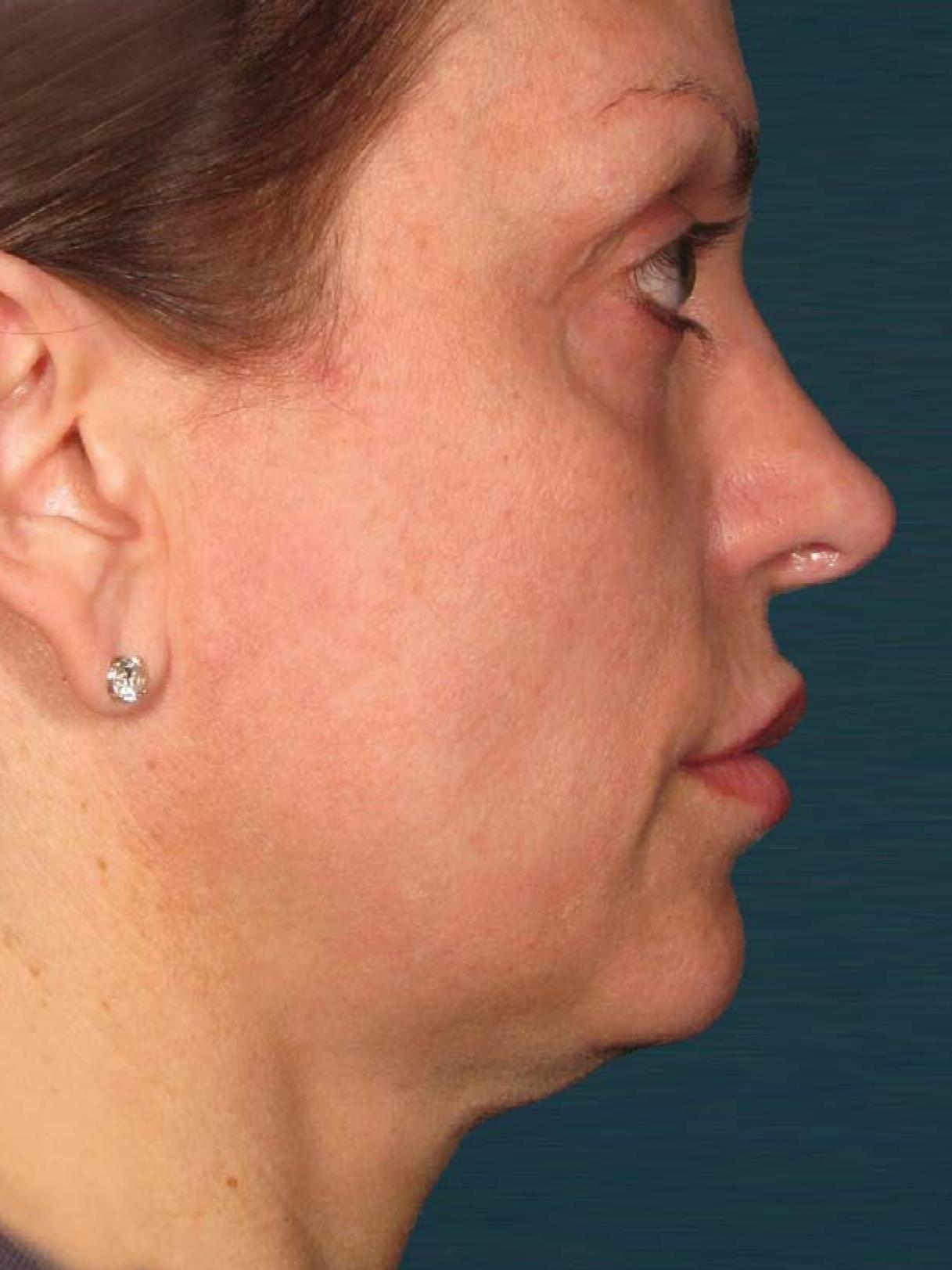 Ultherapy® - Face: Patient 24 - Before 