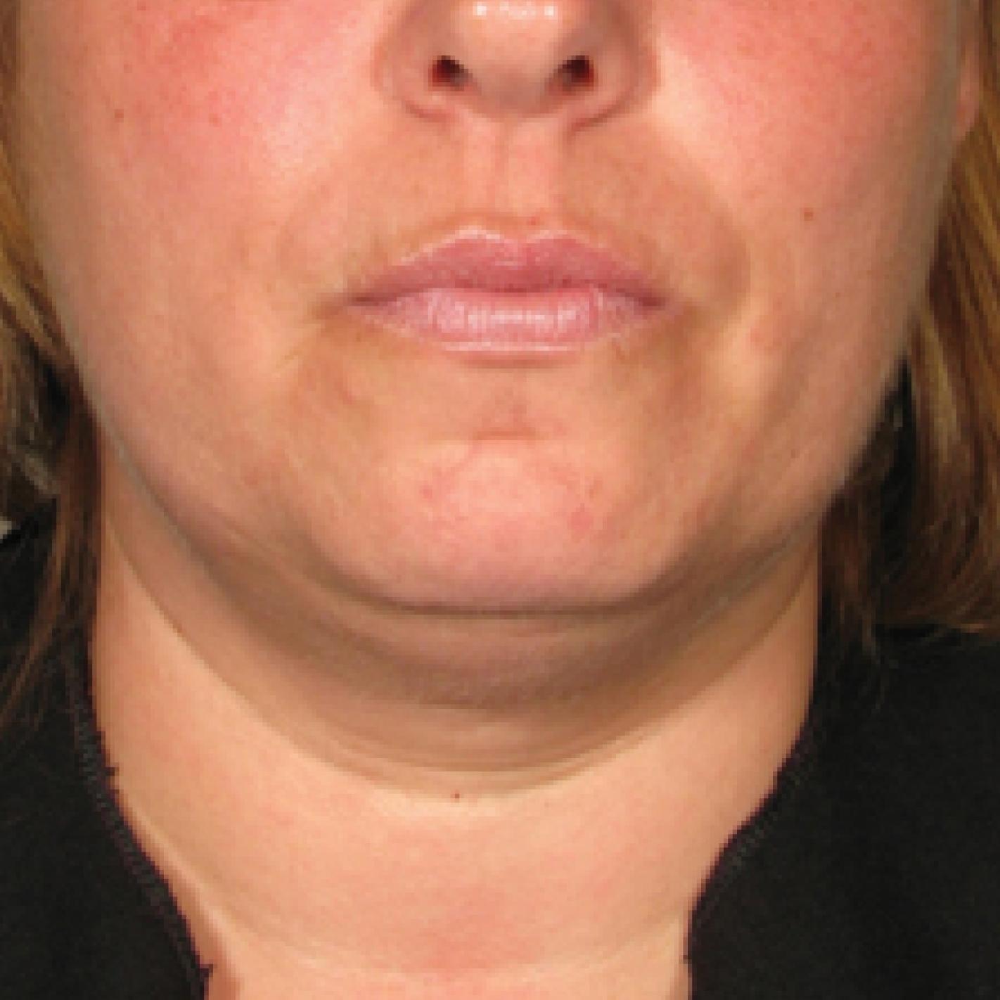 Ultherapy® - Chin: Patient 7 - Before 
