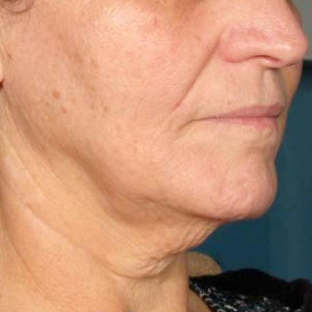 Ultherapy® - Chin: Patient 37 - After 1