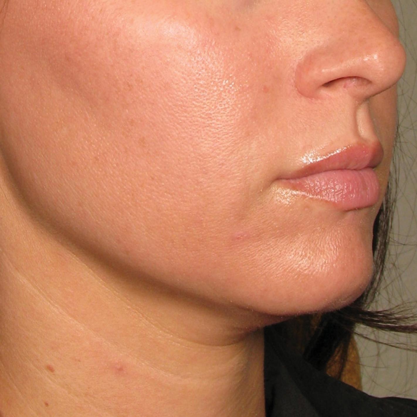 Ultherapy® - Chin: Patient 26 - After 1