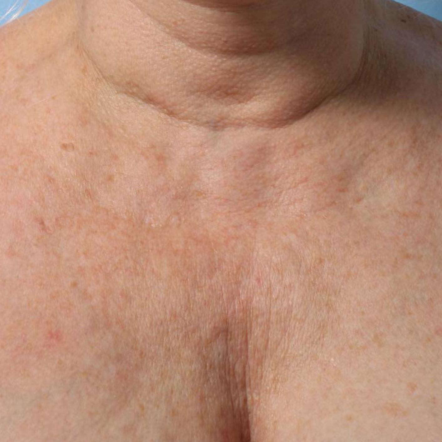 Ultherapy® - Décolletage: Patient 8 - Before 