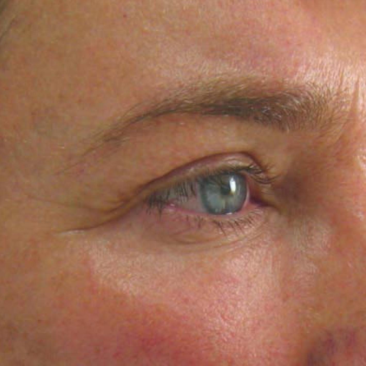 Ultherapy® - Brow: Patient 8 - Before 