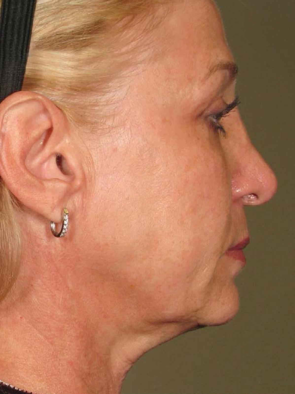 Ultherapy® - Face: Patient 14 - After 