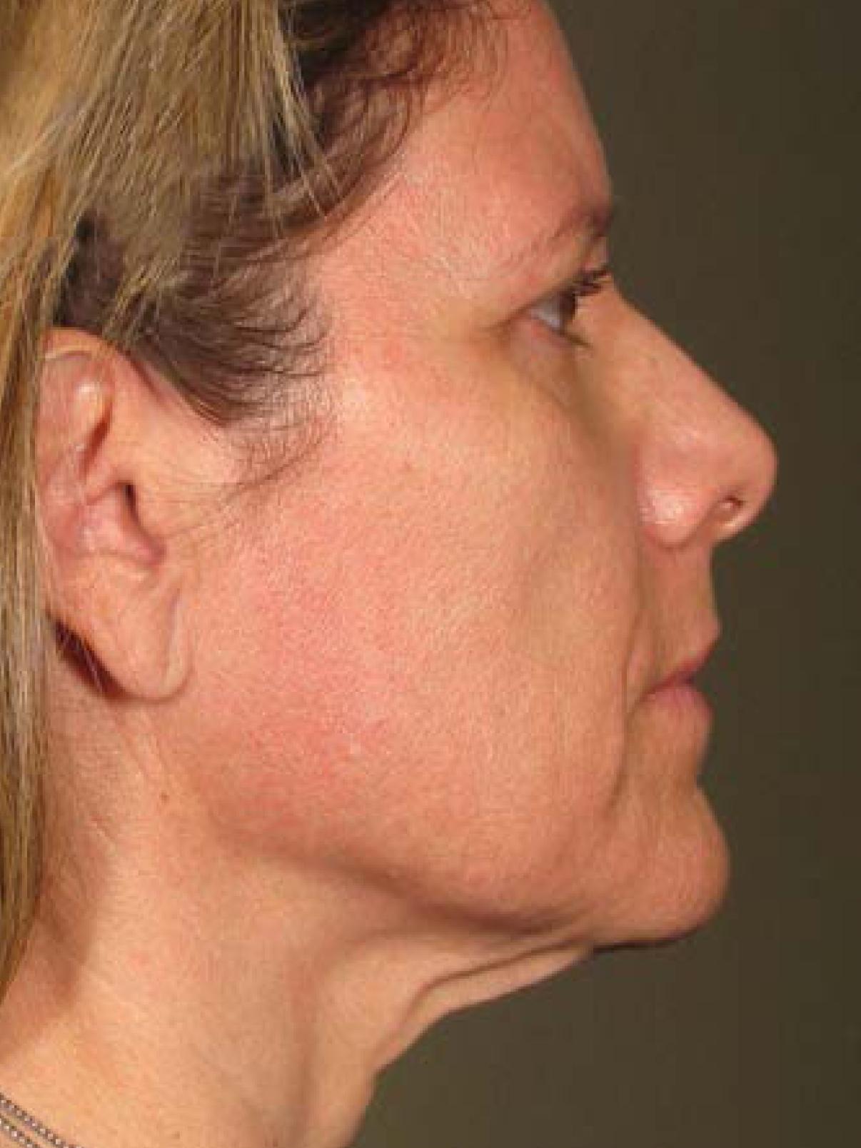 Ultherapy® - Face: Patient 19 - After 1
