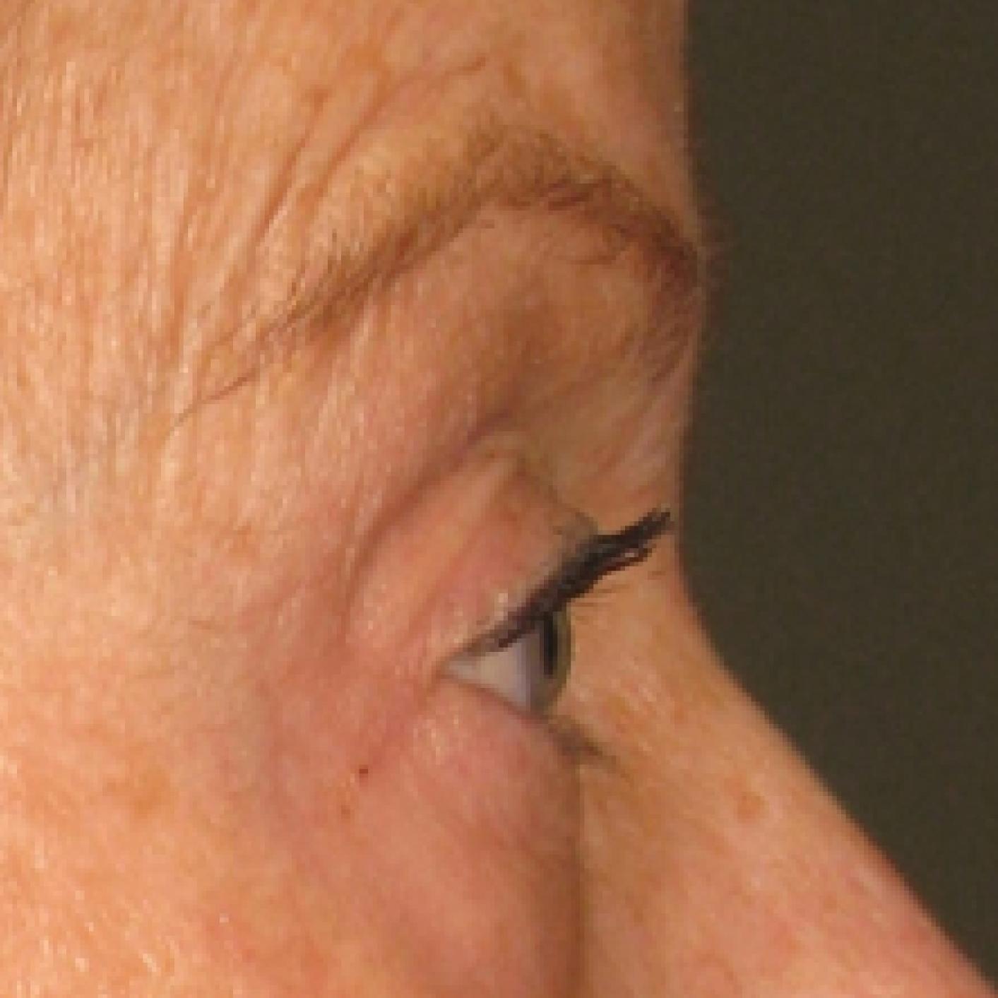 Ultherapy® - Brow: Patient 2 - After  