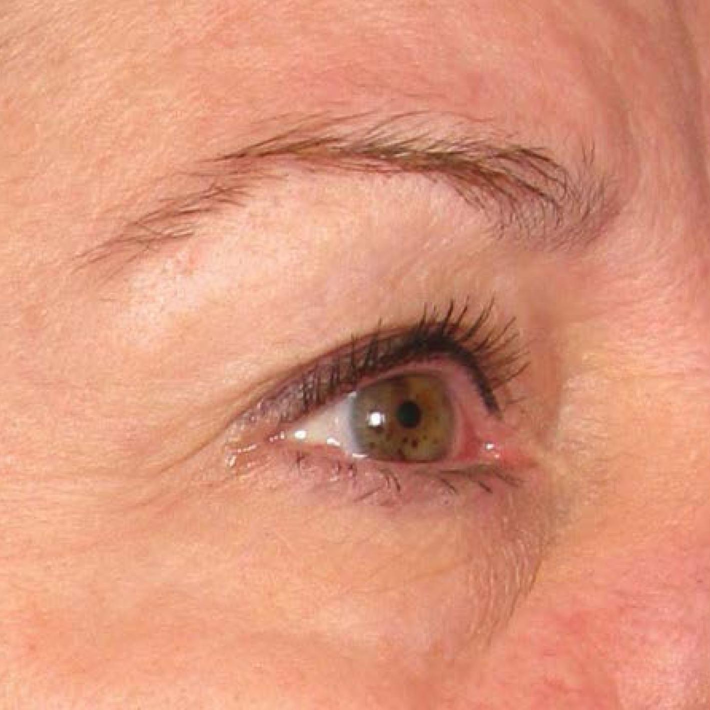 Ultherapy® - Brow: Patient 10 - Before 