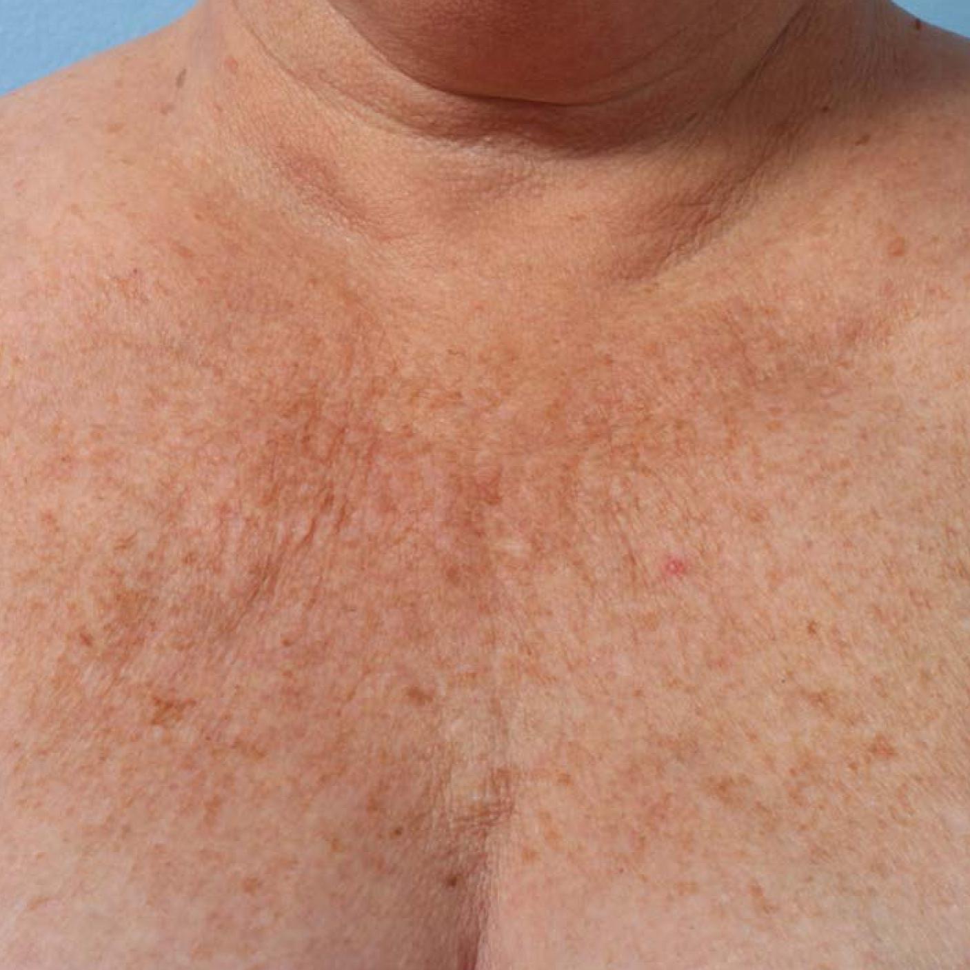 Ultherapy® - Décolletage: Patient 5 - Before 1