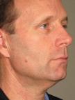 Ultherapy® - Face: Patient 10 - After 