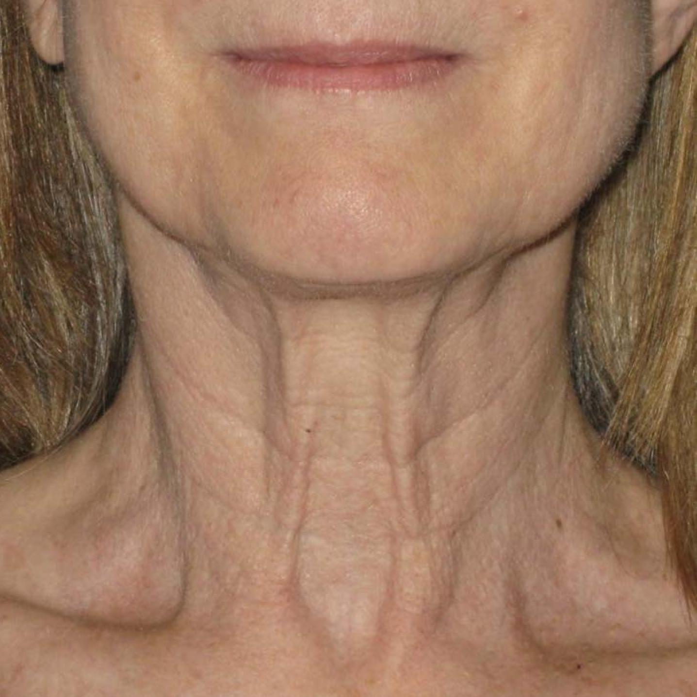 Ultherapy® - Neck: Patient 10 - Before 1