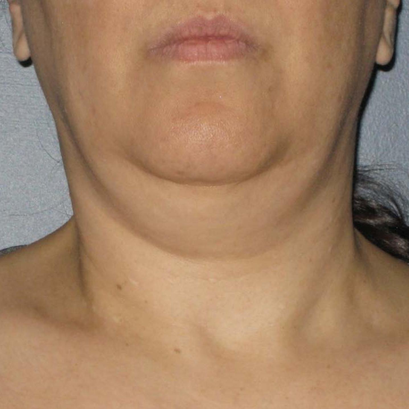 Ultherapy® - Neck: Patient 5 - Before 1