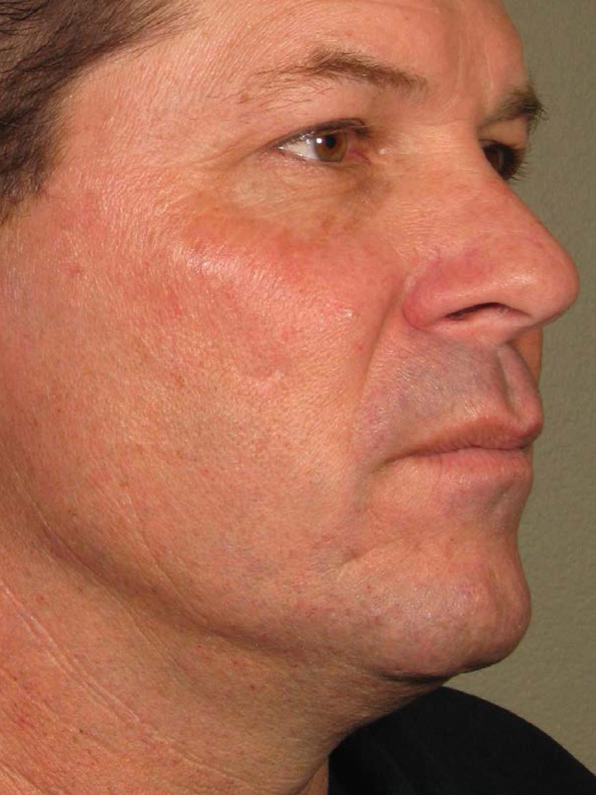 Ultherapy® - Face: Patient 13 - After 