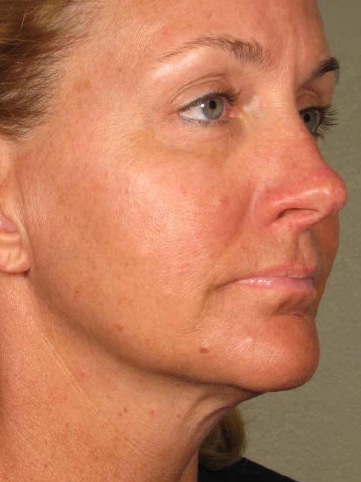 Ultherapy® - Face: Patient 12 - After 