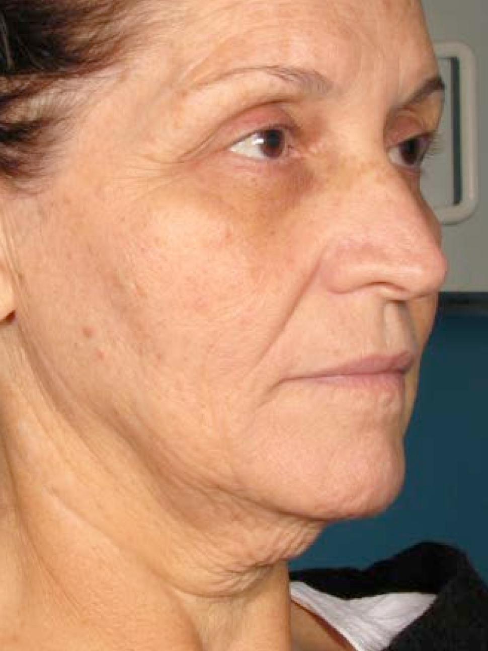 Ultherapy® - Face: Patient 1 - After  