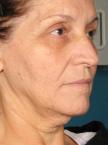 Ultherapy® - Face: Patient 1 - Before 