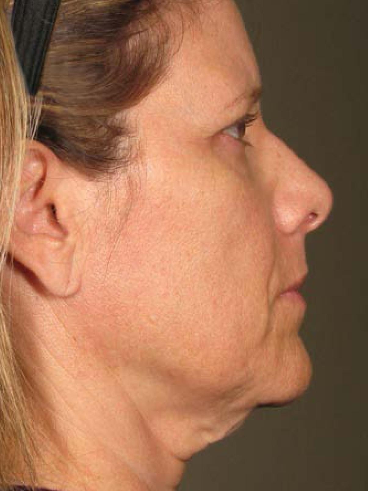 Ultherapy® - Face: Patient 19 - Before 