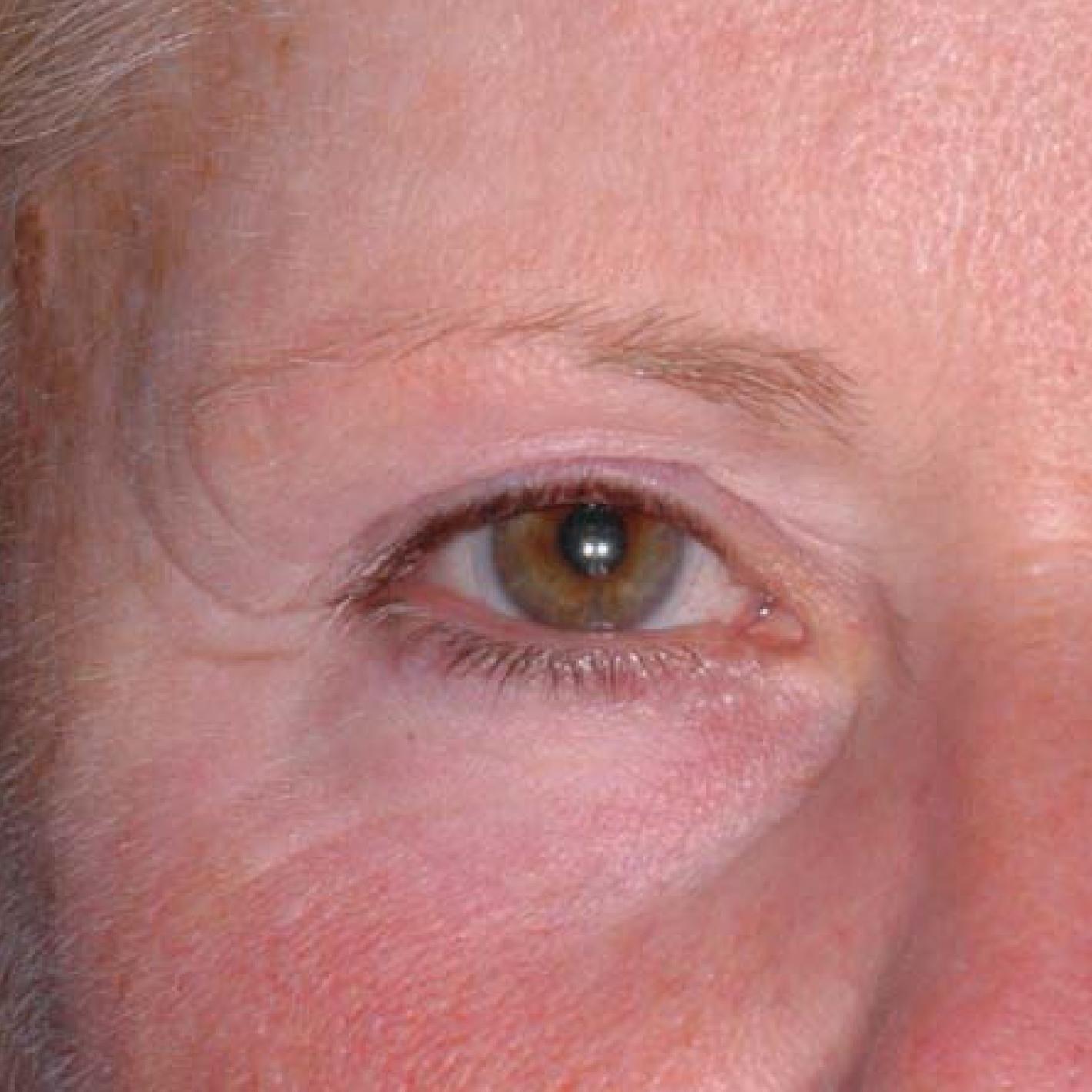 Ultherapy® - Brow: Patient 7 - Before 