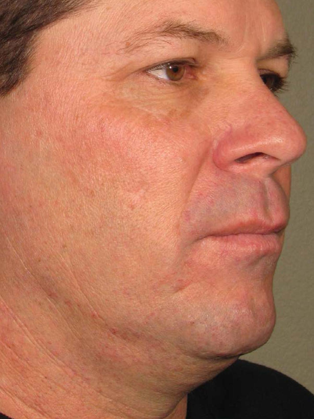 Ultherapy® - Face: Patient 13 - Before 