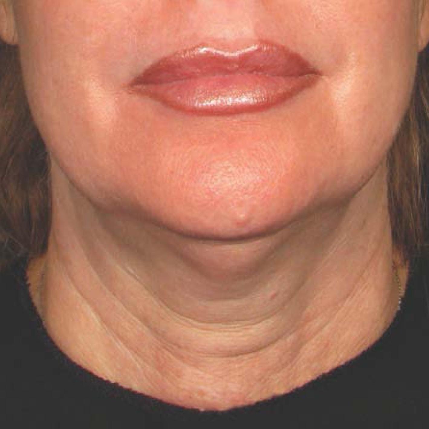 Ultherapy® - Chin: Patient 25 - Before 