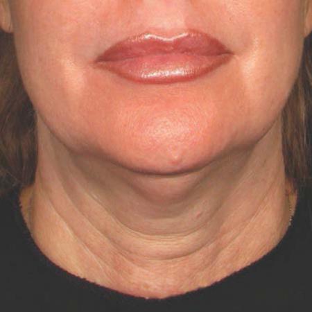 Ultherapy® - Chin: Patient 25 - Before Image