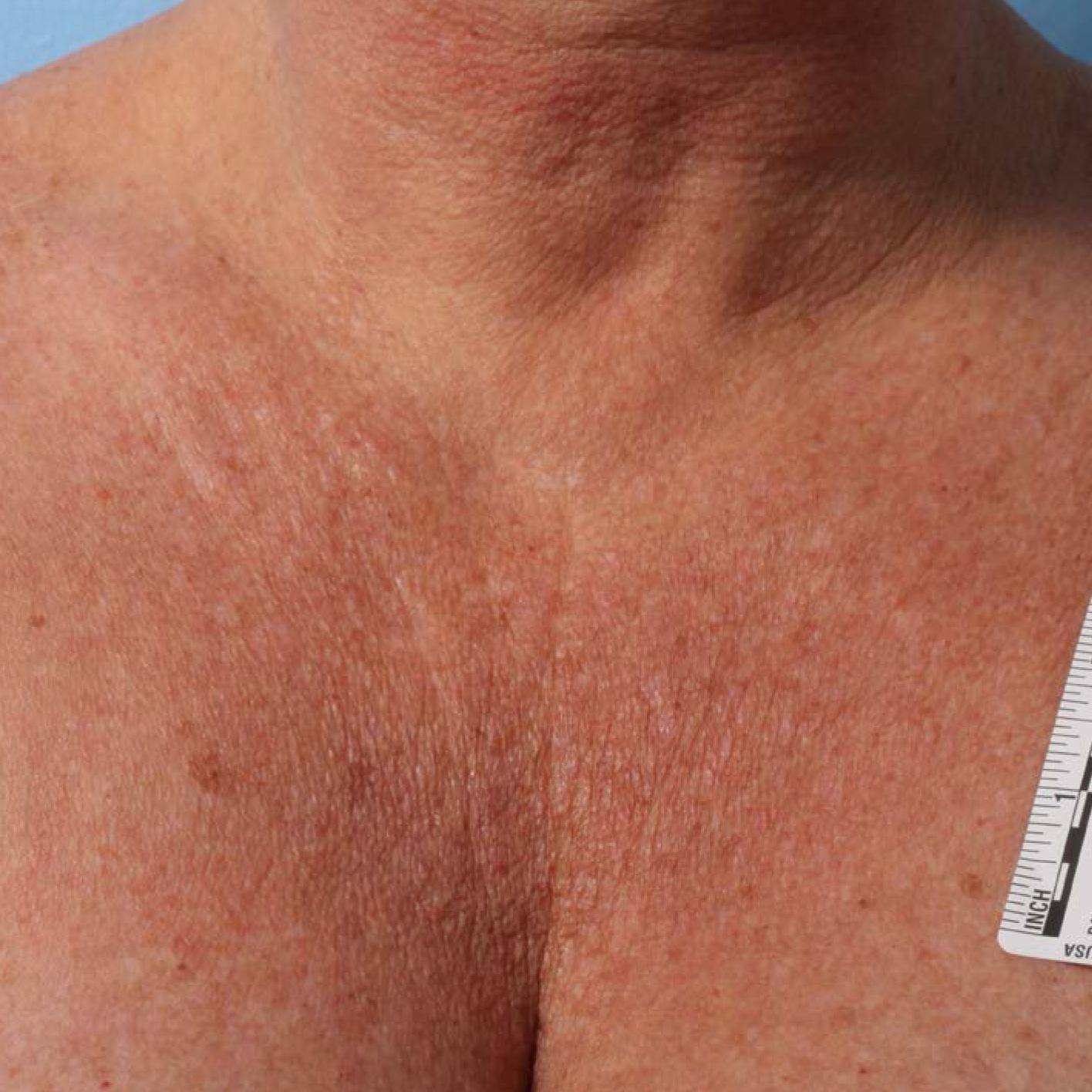 Ultherapy® - Décolletage: Patient 7 - Before 