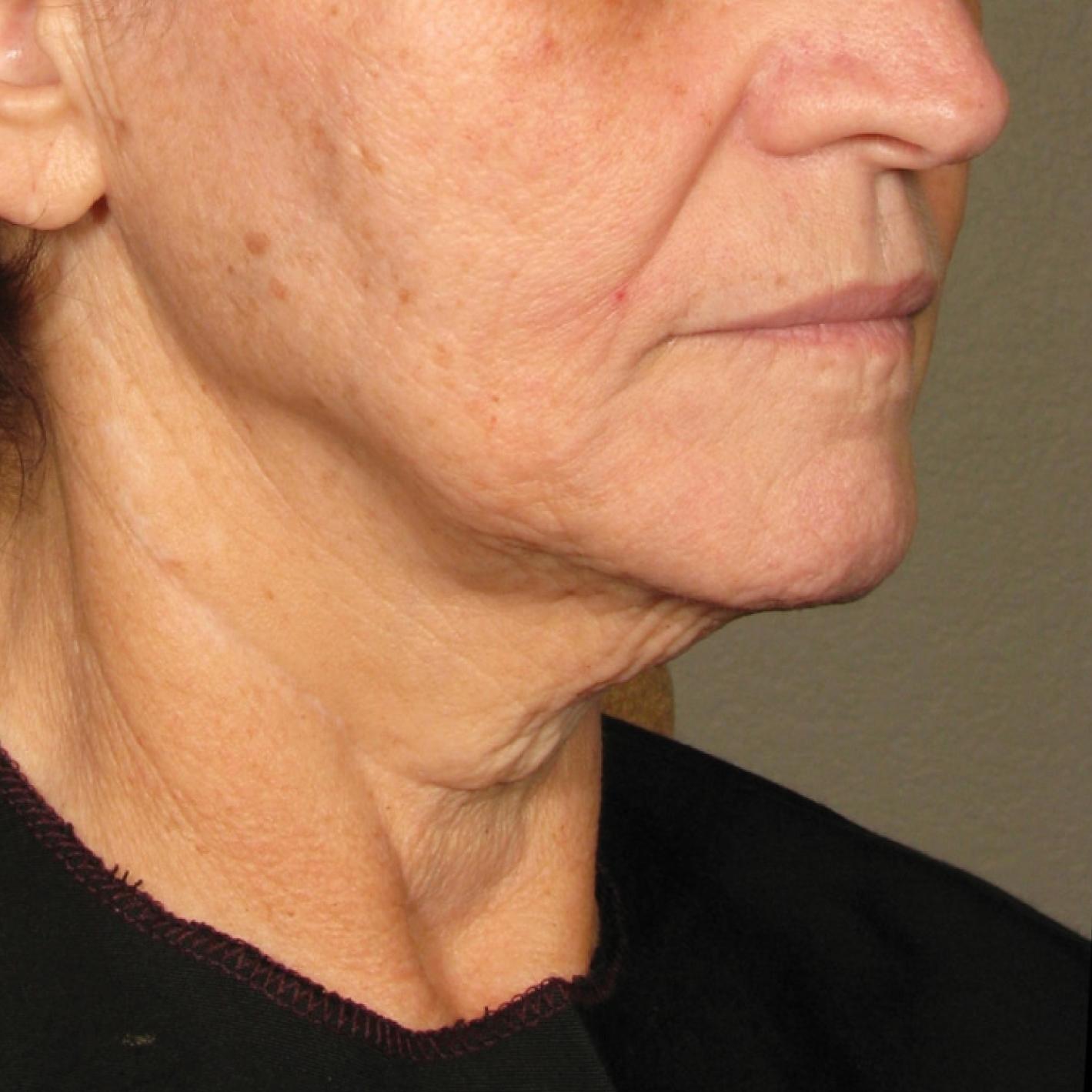 Ultherapy® - Chin: Patient 36 - After 1