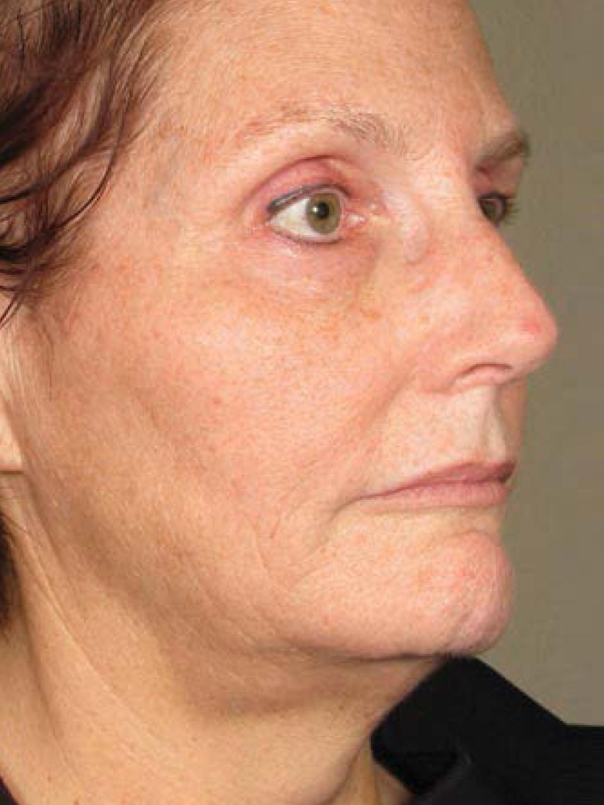 Ultherapy® - Face: Patient 8 - After  