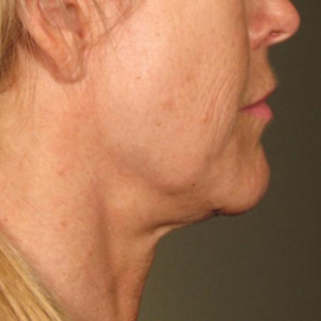 Ultherapy® - Chin: Patient 17 - Before