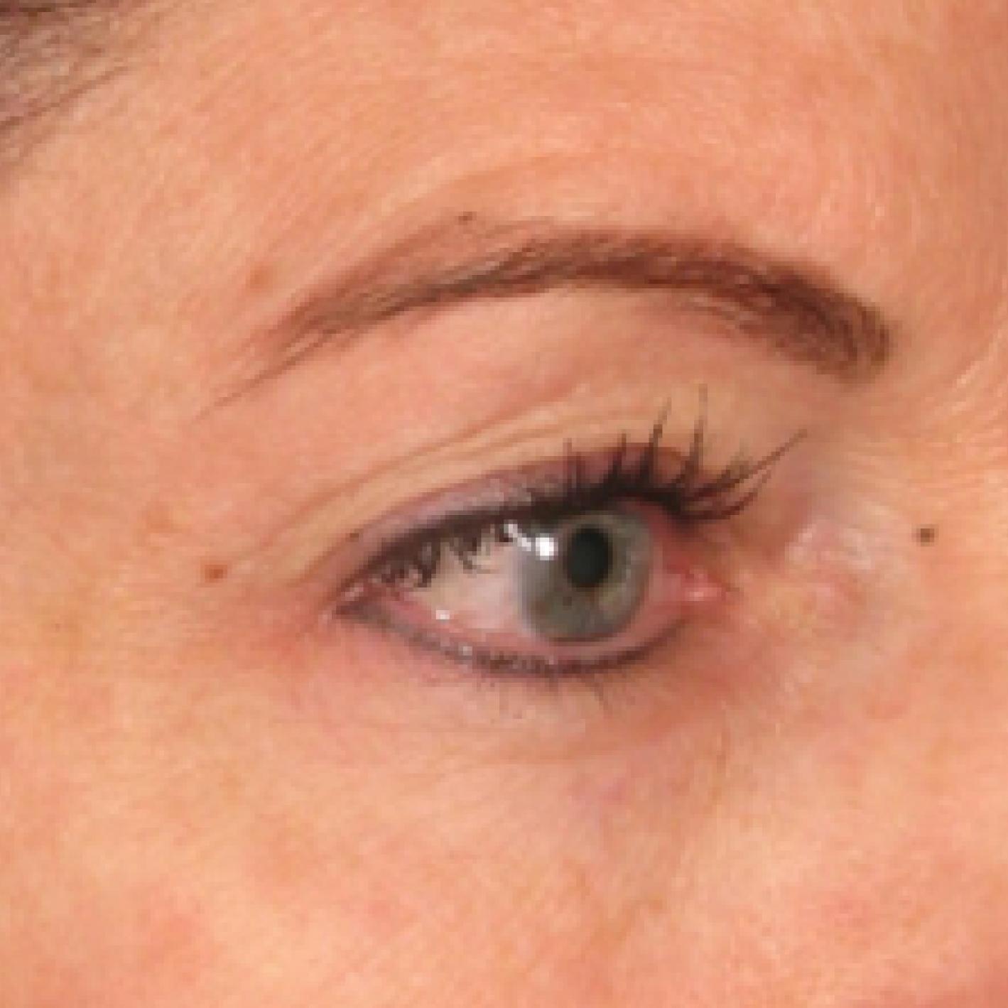 Ultherapy® - Brow: Patient 3 - After  