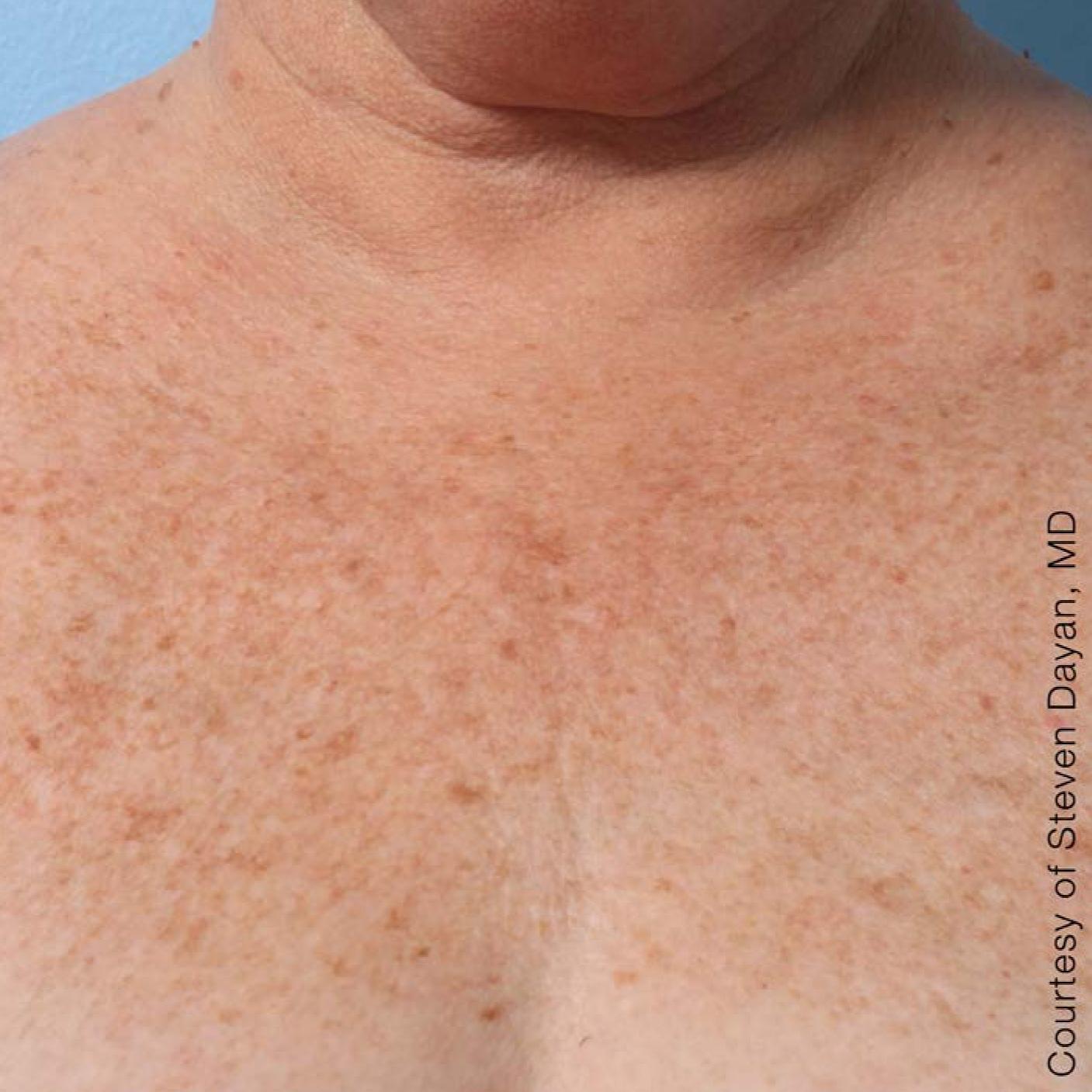 Ultherapy® - Décolletage: Patient 5 - After 1
