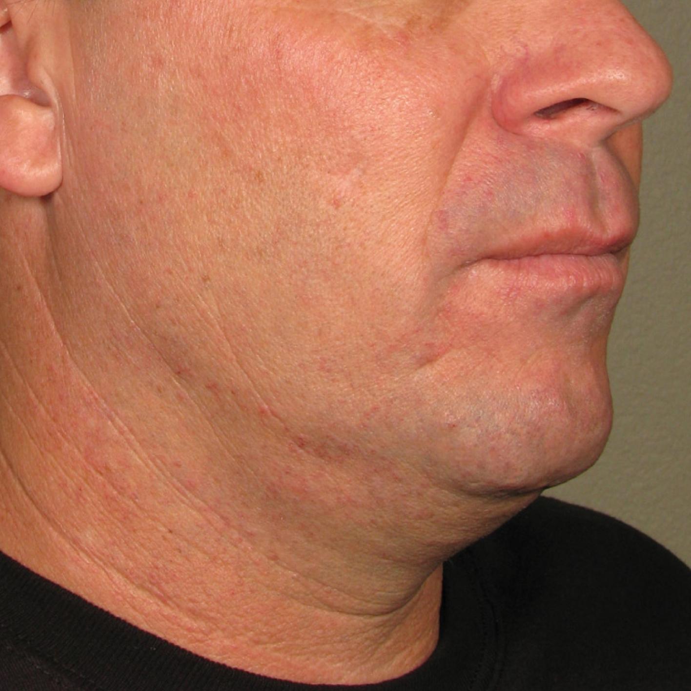 Ultherapy® - Chin: Patient 27 - Before 