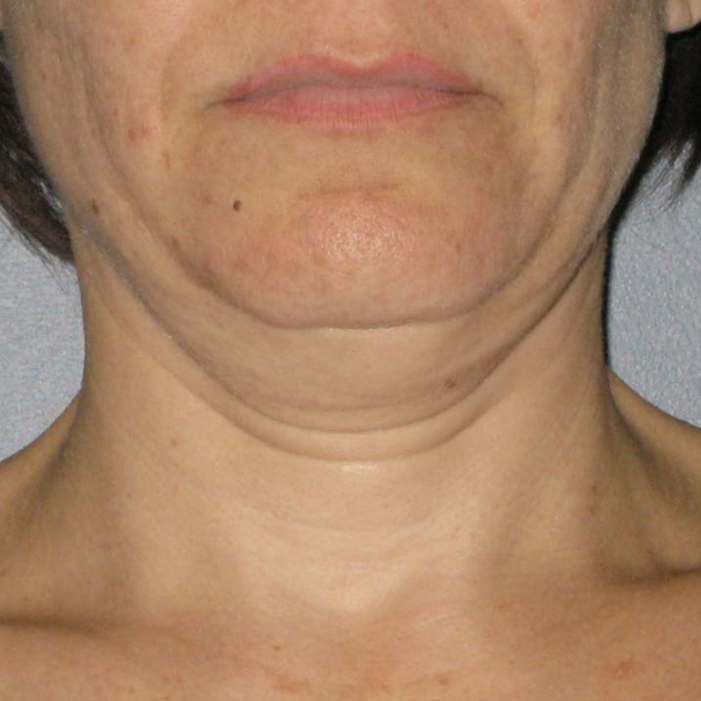 Ultherapy® - Neck: Patient 3 - Before 