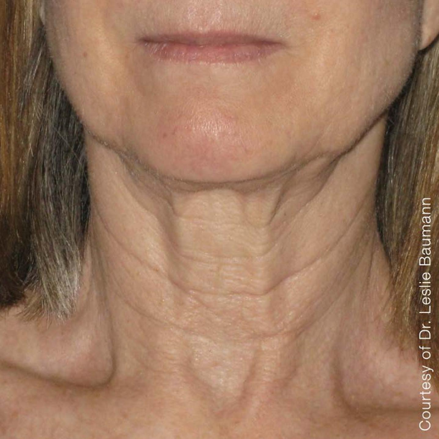 Ultherapy® - Neck: Patient 10 - After  