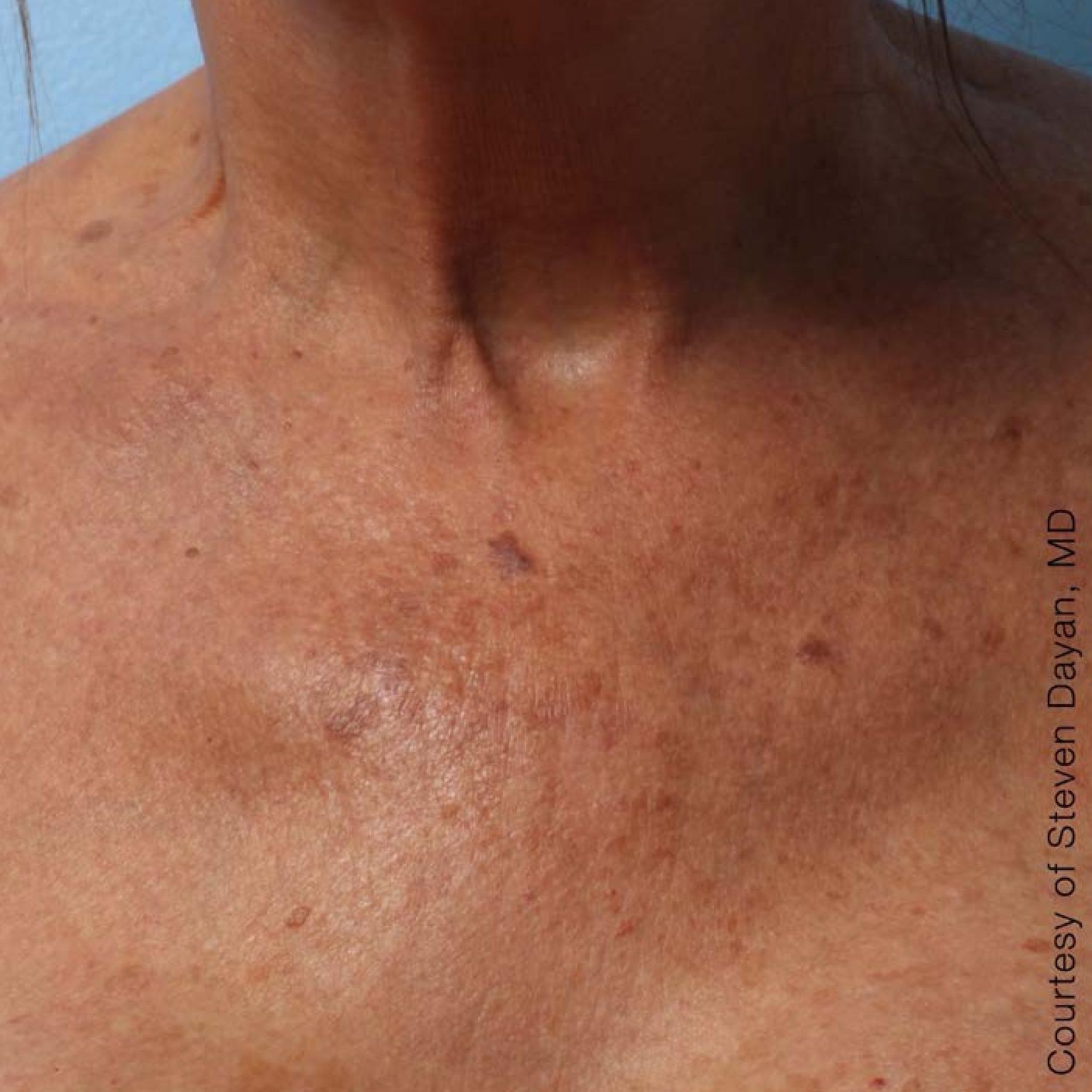 Ultherapy® - Décolletage: Patient 3 - After 1
