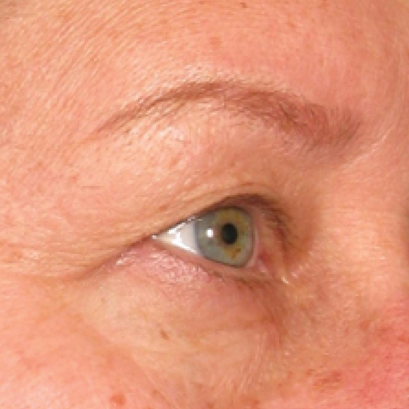 Ultherapy® - Brow: Patient 4 - Before 