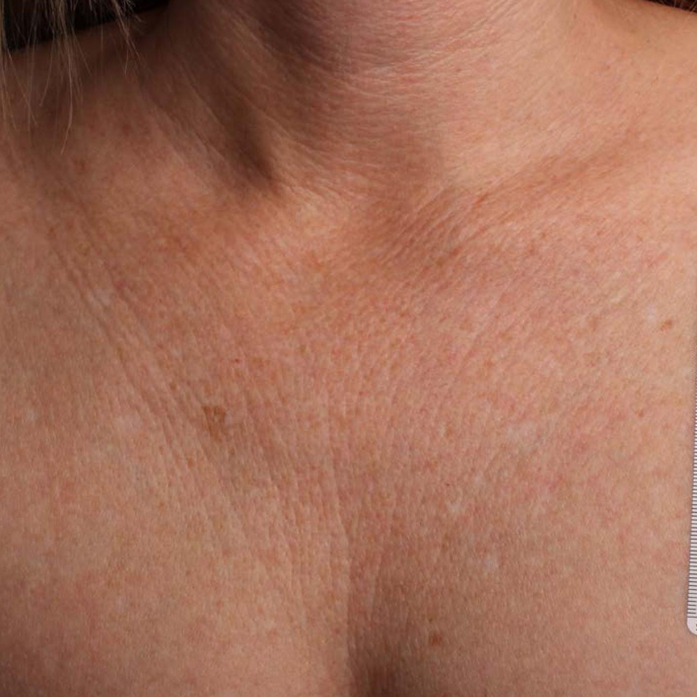 Ultherapy® - Décolletage: Patient 18 - Before 