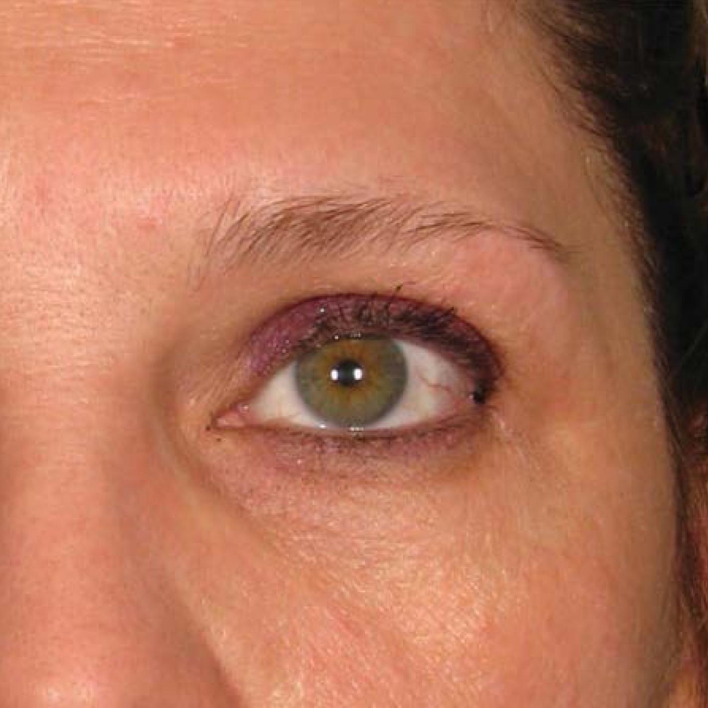 Ultherapy® - Brow: Patient 12 - Before 