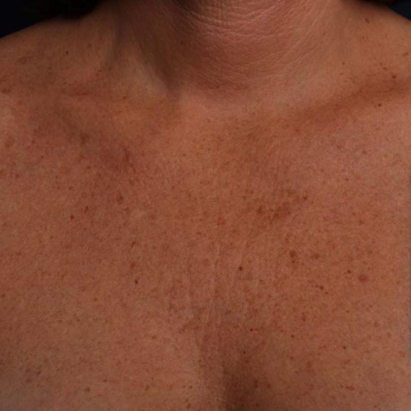 Ultherapy® - Décolletage: Patient 14 - Before 