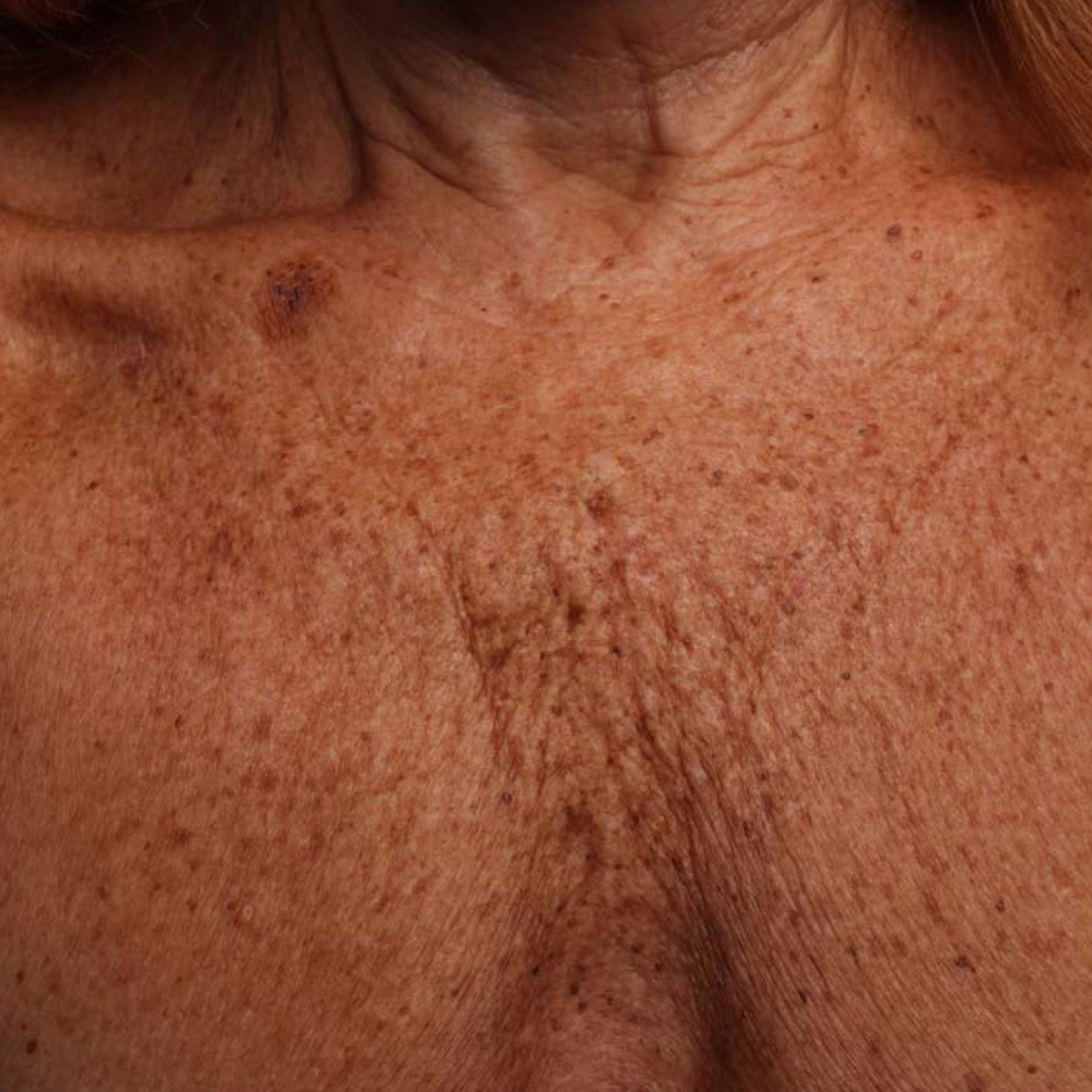 Ultherapy® - Décolletage: Patient 12 - Before 1