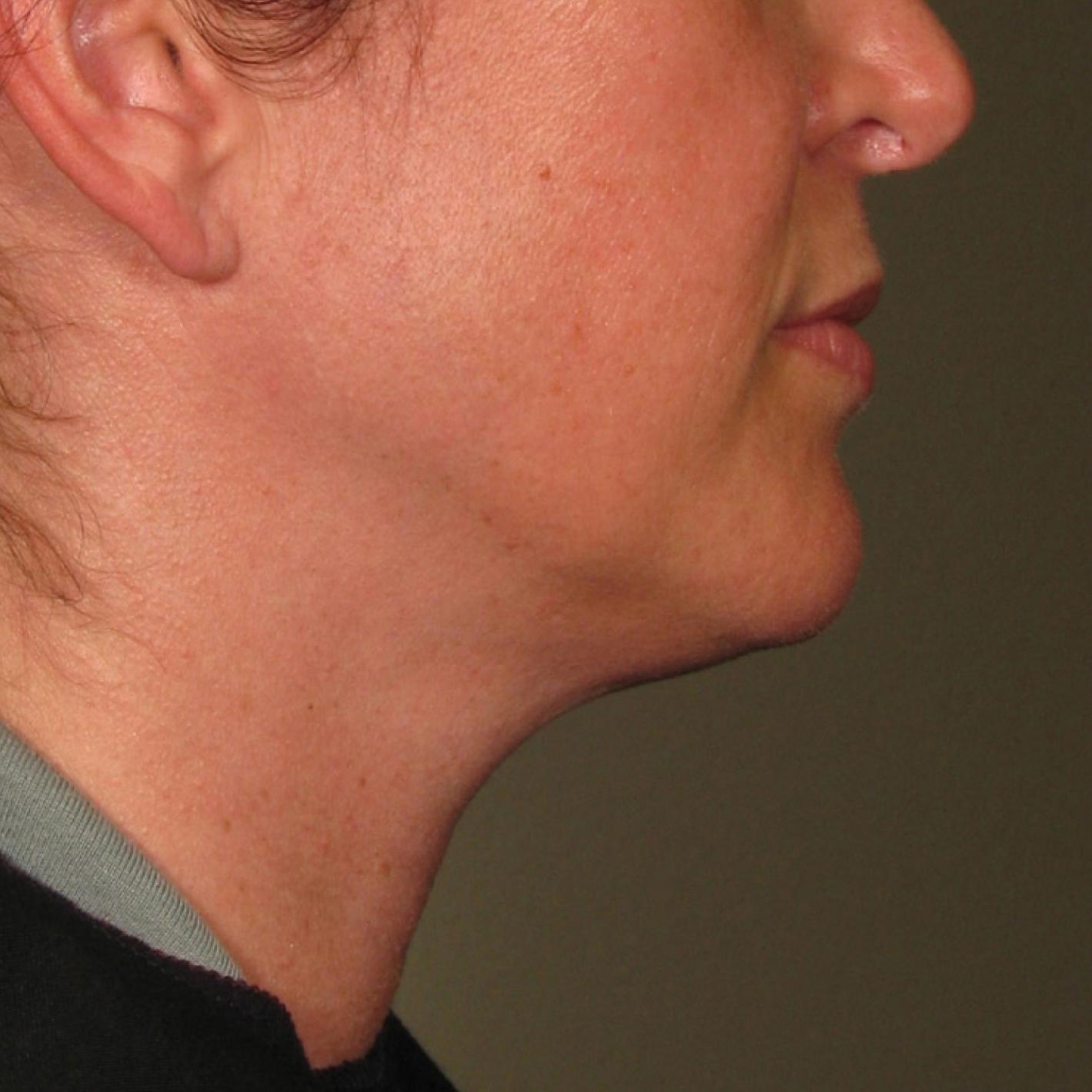 Ultherapy® - Chin: Patient 21 - After 