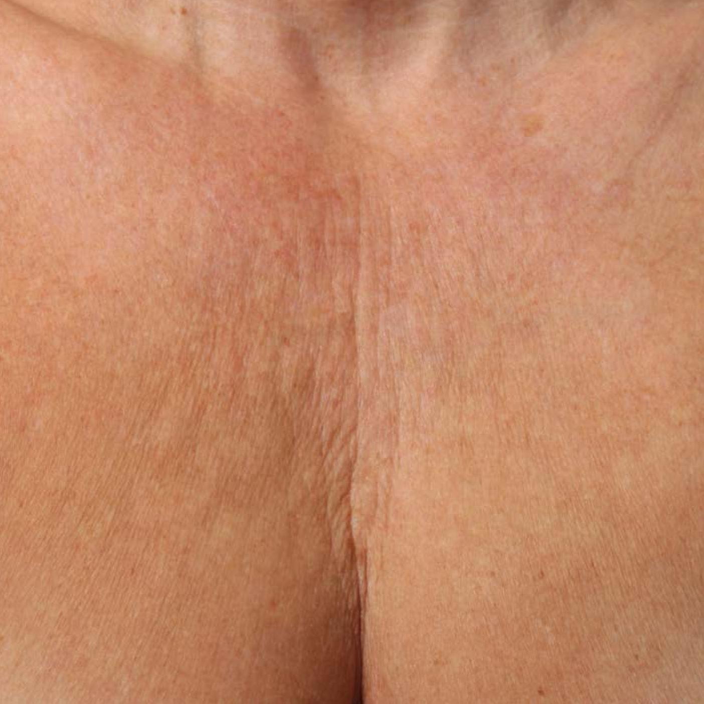 Ultherapy® - Décolletage: Patient 4 - Before 