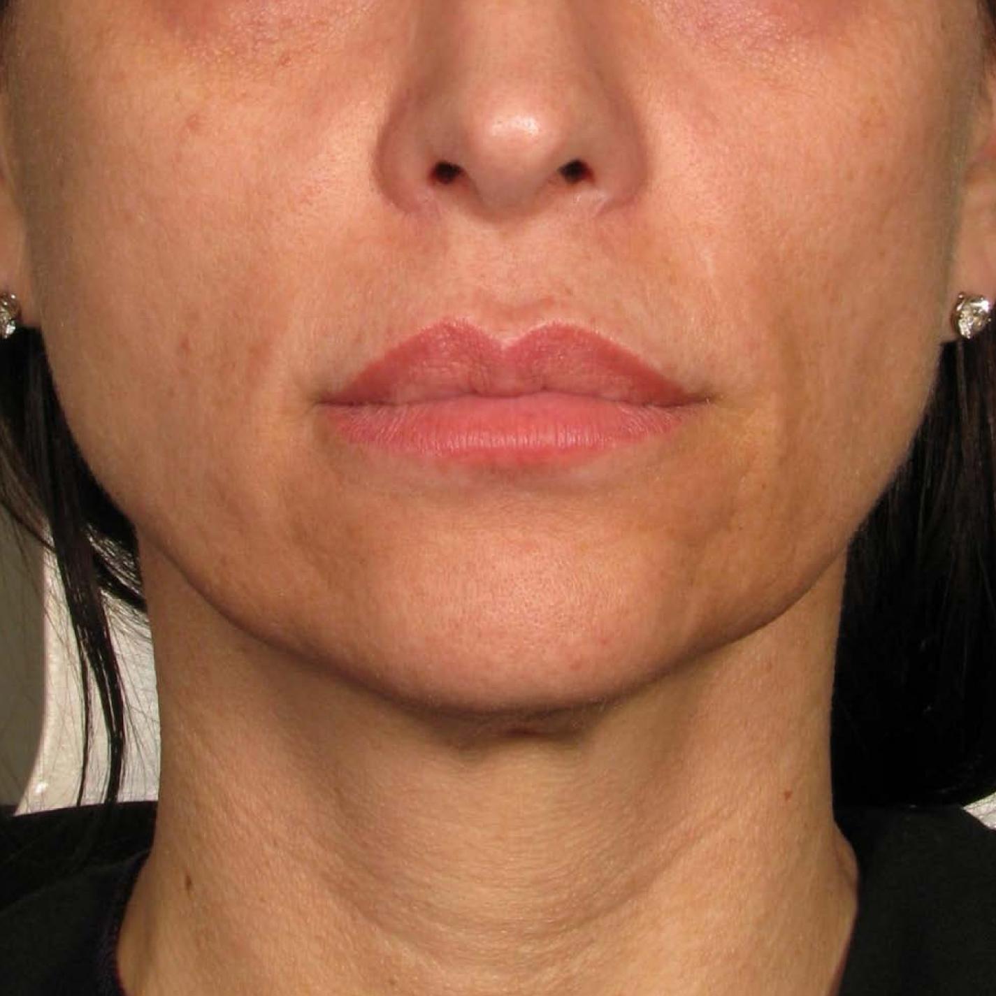 Ultherapy® - Chin: Patient 39 - After 