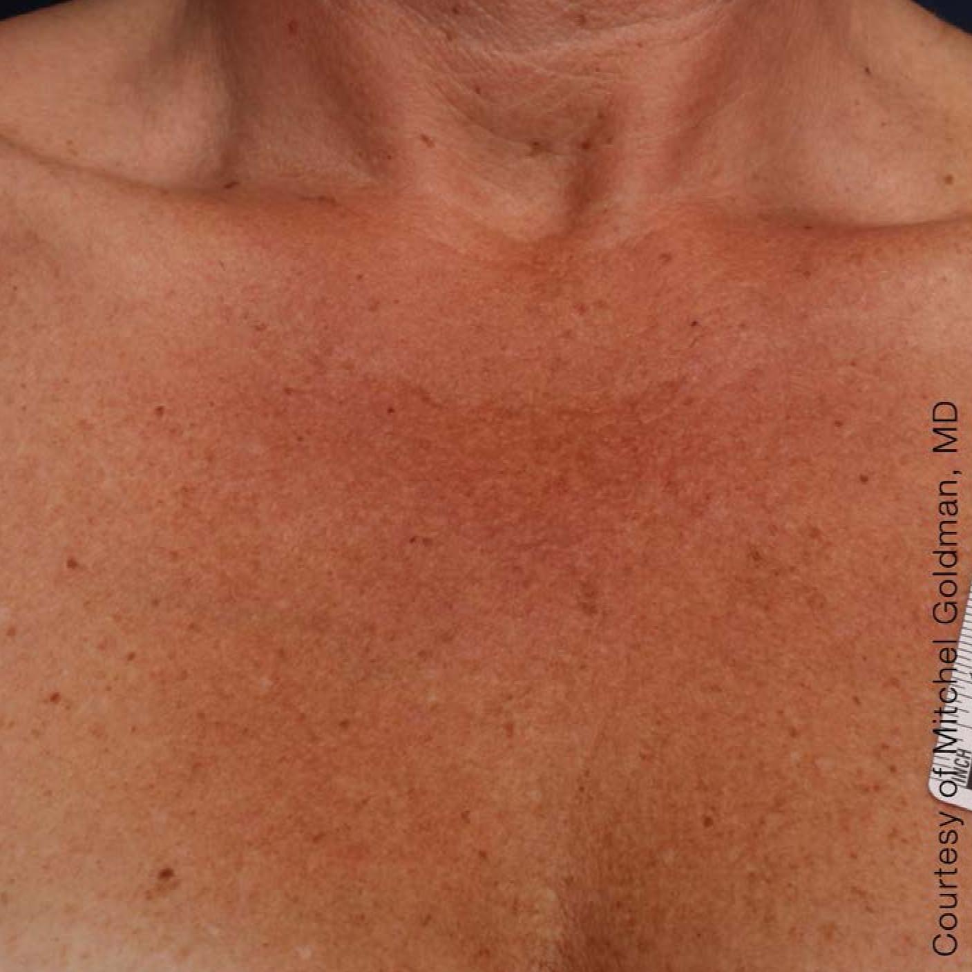 Ultherapy® - Décolletage: Patient 16 - After 