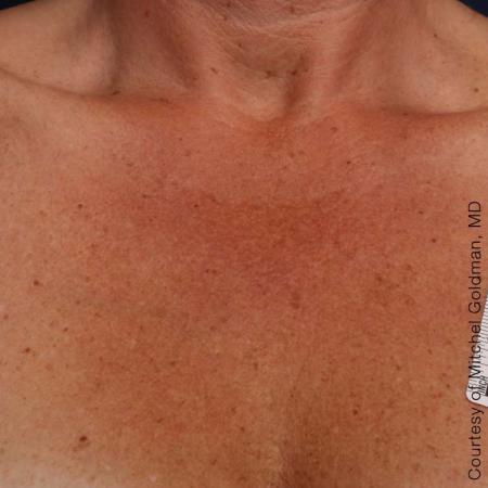 Ultherapy® - Décolletage: Patient 16 - After 1