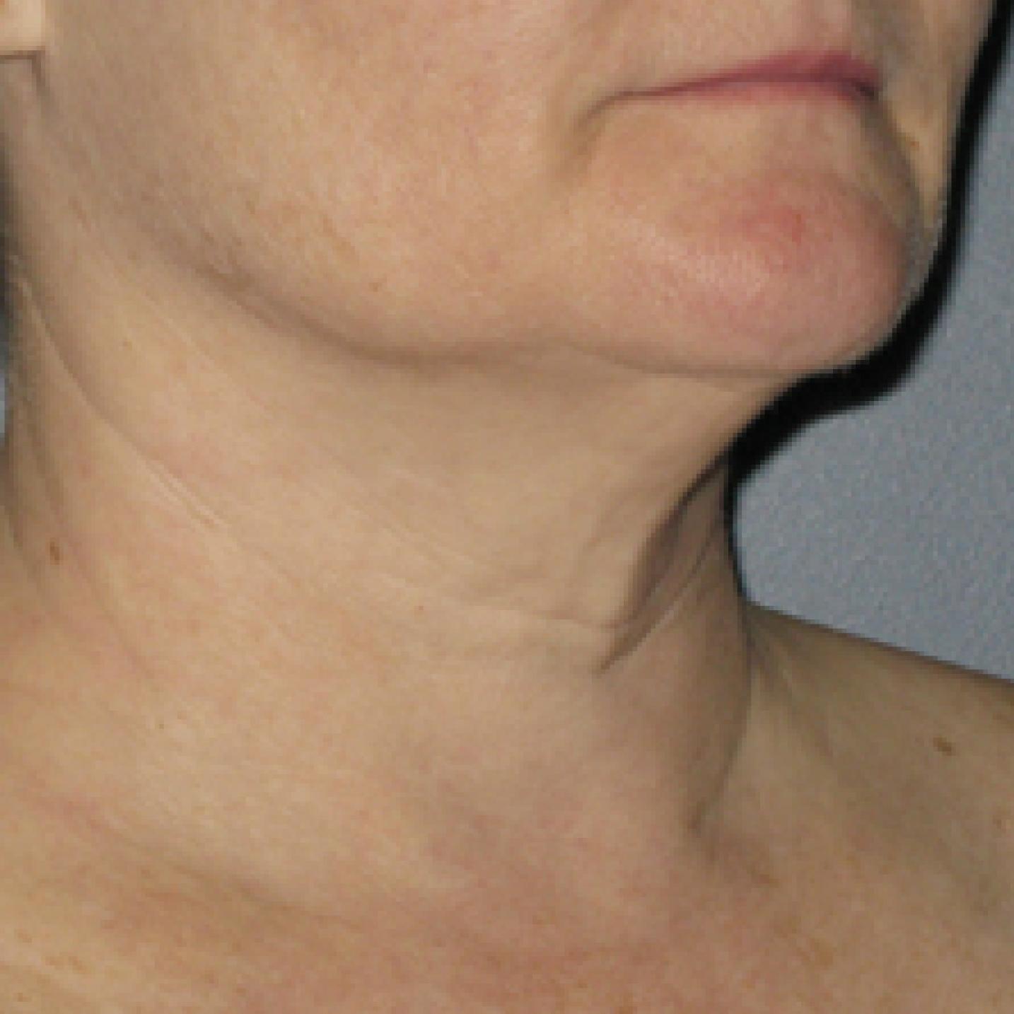 Ultherapy® - Neck: Patient 2 - After  