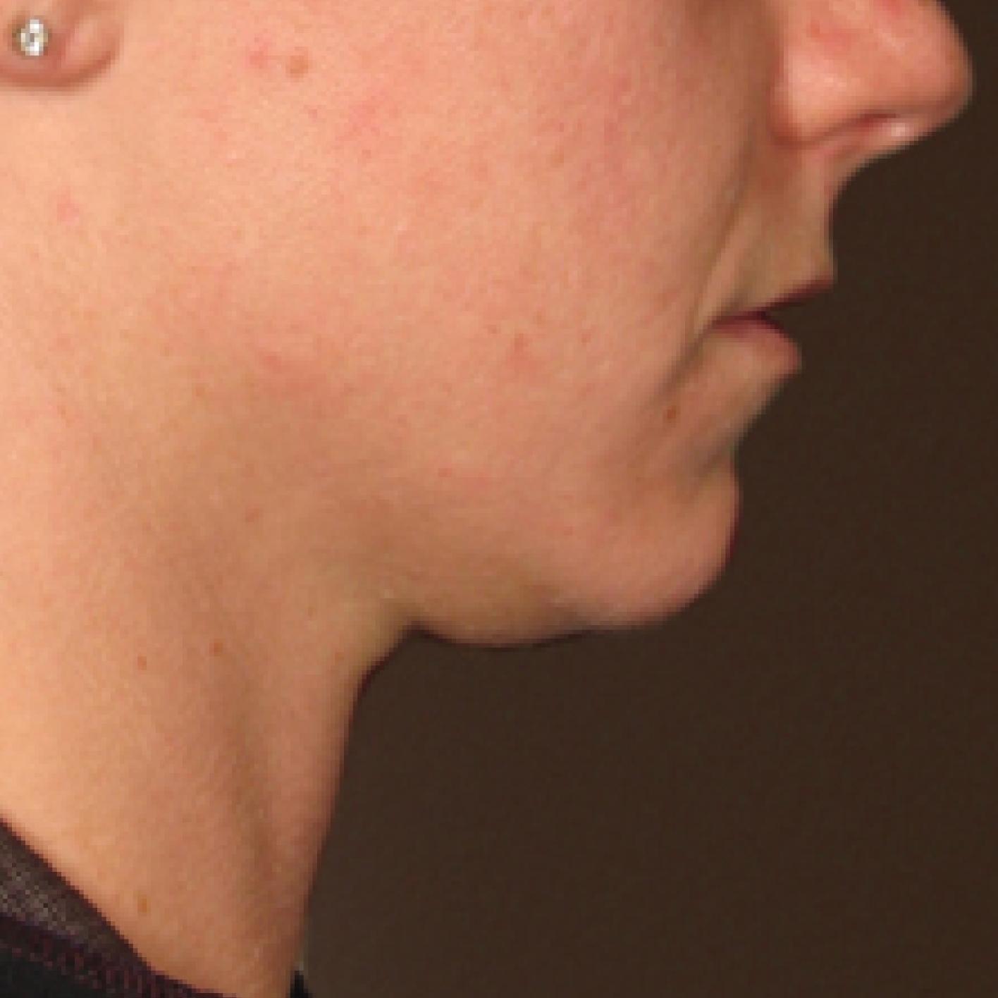 Ultherapy® - Chin: Patient 15 - Before 